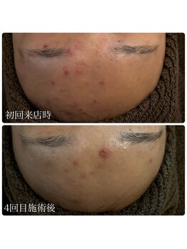 ブリエ(Briller)/2週間に一度のケア4回目♪