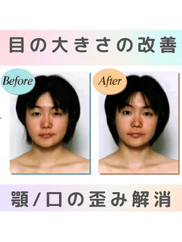 ロコモ 美容矯正サロン(Locomo)/左右対称の小顔：目の大きさ改善