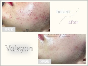 ヘティ バイ ソウル 中目黒(HETIY by Seoul)/肌質改善・肌再建コース◇3回目