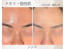 スリースリー(THREE THREE)/テカリ・脂性肌ケア