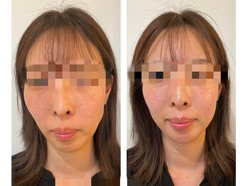 ペルナ(perna)/小顔ストレスケアフェイシャル