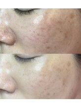 エミュ(emu)/シミケアで肌育