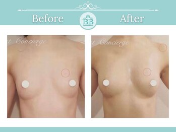 美人バスト 柏店/【バストアップ・育乳】症例