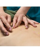 金町5丁目鍼灸マッサージ院/鍼灸施術の様子