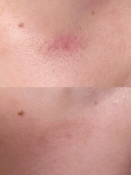 オニュ(onyu)/肌荒れ悩みもダーマで解決！