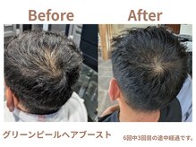 アリー(Alii)/分け目の薄さ改善Before→After