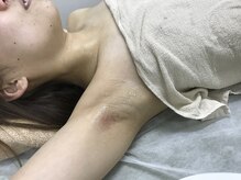 ナノハナ/鹿沼市本格全身脱毛ナノハナ