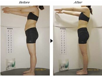 ビューティークリニックコダマ 宮崎本店/【2か月コース】A.K様（21歳）