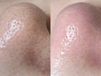 エレヌイ(ELENUI)/毛穴黒ずみ/詰まり改善