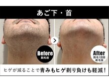 RBL ドン・キホーテ川越東口店/メンズ脱毛/ヒゲ脱毛1回目剃毛後