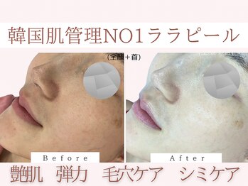 Cスキンケアクリニック 麻布店/ララピールBeforeAfter#乾燥