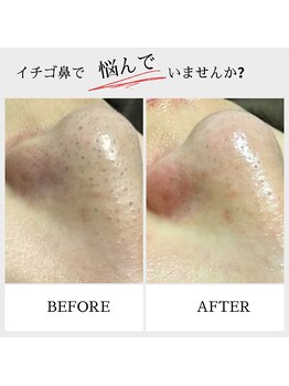 フルーヴ ルフレ(Fleuve Reflet)/酷い黒ずみ毛穴の方にオススメ！