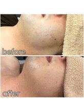 キガルモ 宇都宮店/脱毛ビフォーアフター