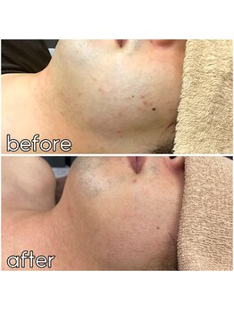 キガルモ 宇都宮店/脱毛ビフォーアフター