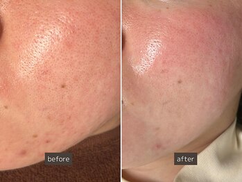 SEC(Shizuoka esthetic company)/【ニキビケア】本気の肌質改善