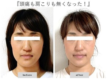 エピファニー(Epiphany)/30代　頭の痛みと浮腫み感が…