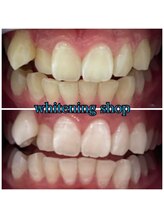 ホワイトニングショップ 武蔵小杉店/武蔵小杉ホワイトニング美白ケア