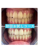 ホワイトニングルーム 横浜店(Whitening Room) 頑固な着色 改善