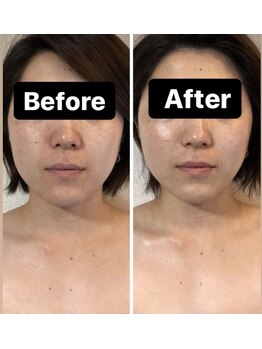 小顔コルギサロン シー(She)/【コルギ】1度の変化!