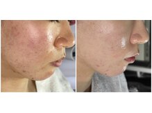 レイ(Rey)/セルマン肌管理　本気の肌質改善