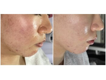 レイ(Rey)/セルマン肌管理　本気の肌質改善