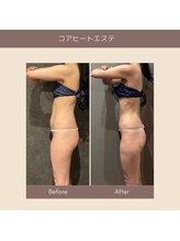 エクラ(ECLAT)/コアヒート痩身