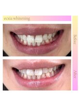 エクシアホワイト 新宿御苑店(ecxia white)/ホワイトニングビフォーアフター