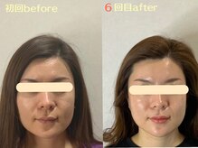 エスポワール(espoir)/初回before・６回目after