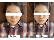 ダイアリー(DIARY)/小顔矯正