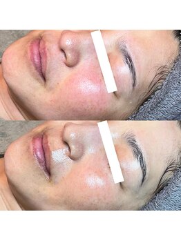 フィエルテ(Fielte)/赤み/ハリ/艶肌