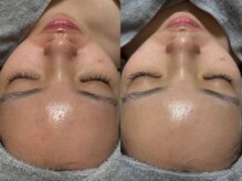 トモニ(TOMONI)/ダクトピールフェイシャル1回