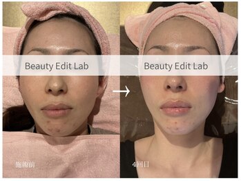 ビューティーエディットラボ(Beauty Edit Lab)/ハーブピーリング4回の変化!