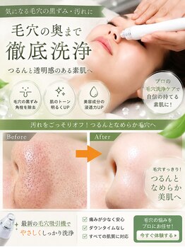 トータルビューティーサロン リリ(Riri)の写真/【毛穴洗浄＋毛穴吸引＋毛穴引き締め】スペシャルケア