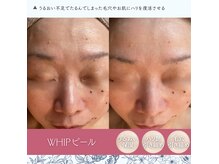 泡のきもちの雰囲気（贅沢な生泡美容液×微細針☆WHIPピールで超保湿◎ハリと毛穴〆）