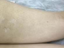 ナノハナ/鹿沼市本格全身脱毛ナノハナ