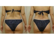 アルマ 芦屋(ALMA)/急な予定にも♪リジュケア痩身♪