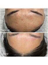 スムー 金沢小橋町店(Smoo)/ハーブピーリング