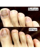 リゼラアンドコー 川越南古谷店/抗がん剤した方の爪