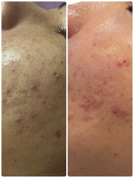 ローズ 下松(ROSE)/【光フェイシャル4回後】