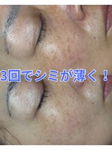 スパッツィオ(spazio)/【セラピール&フォト美顔3回目】