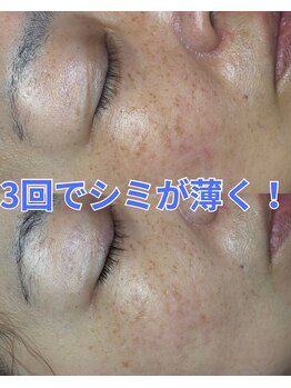 スパッツィオ(spazio)/【セラピール&フォト美顔3回目】