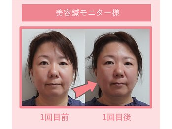 グリーンノア鍼灸院/40代女性美容鍼1回目の変化