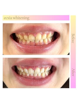 エクシアホワイト 新宿御苑店(ecxia white)/ホワイトニングビフォーアフター