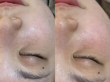 ビーマジック(Be Magic)/大人気！毛穴洗浄！