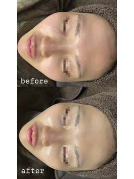 エクラ(ECLAT)/ピーリング×クールビタミン導入