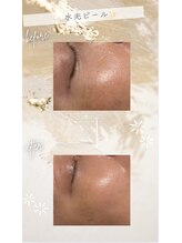 ルミナ(Lumina)/WIQO水光ピール