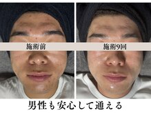 ハーブピーリングHYの雰囲気（男性も安心して通える◎エステ初心者でも緊張せずご来店可能！）
