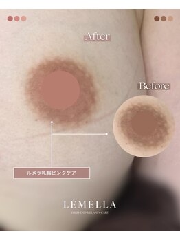 エルビービュティーサロン(LB BEAUTY SALON)/【ルメラ乳輪】実績数関西1★