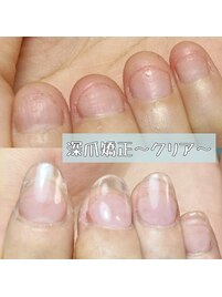 深爪矯正のクリアシンプル