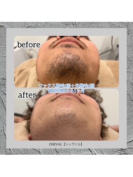 シュバル(CHEVAL)/ヒゲ脱毛はCHEVALにお任せ下さい